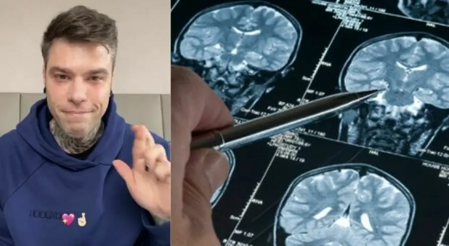 Demielinizzazione cos' è? Sintomi e cura, Nervo Ottico: cos'ha fatto Fedez?