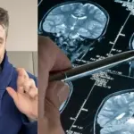 Demielinizzazione cos' è? Sintomi e cura, Nervo Ottico: cos'ha fatto Fedez?