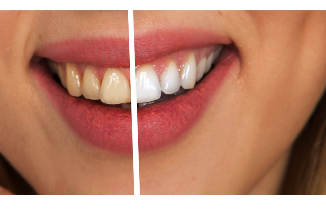 Come sbiancare i denti a casa con rimedi naturali sbiancamento denti denti bianchi sbiancante denti  acqua ossigenata denti bicarbonato denti sbiancamento denti fai da te  sbiancare denti