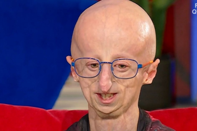 Sammy Basso a Oggi è un altro giorno fa commuovere tutti prendo  malattia invecchiamento precoce  progeria casi in italia progeria malattia  progeria italia  sammy invecchiamento precoce  progeria foto 